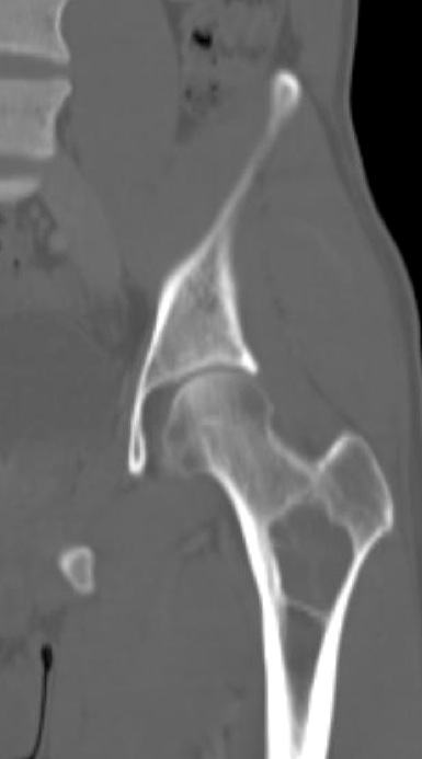 Figure 2 for case fibrous dysplasia ( RID3738 )